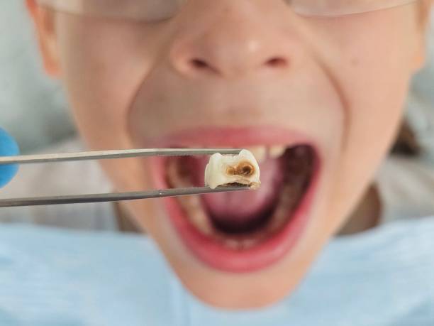 Best Dentist for Tooth Abscess  in Morganfield, KY
